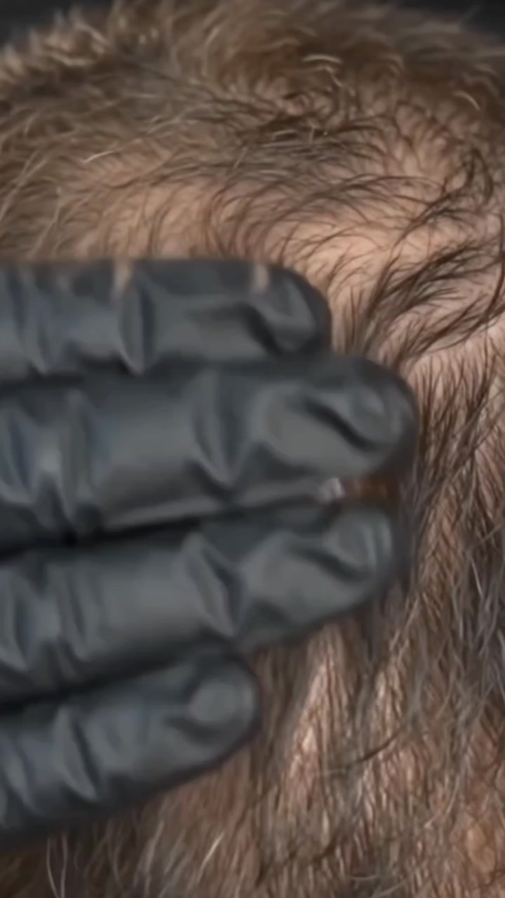 Video 3 of 6: demonstration of the concealer being applied to thinning areas.